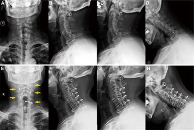 A novel surgical technique for cervical laminoplasty in patients with multilevel cervical spondylotic myelopathy: A case report and literature review